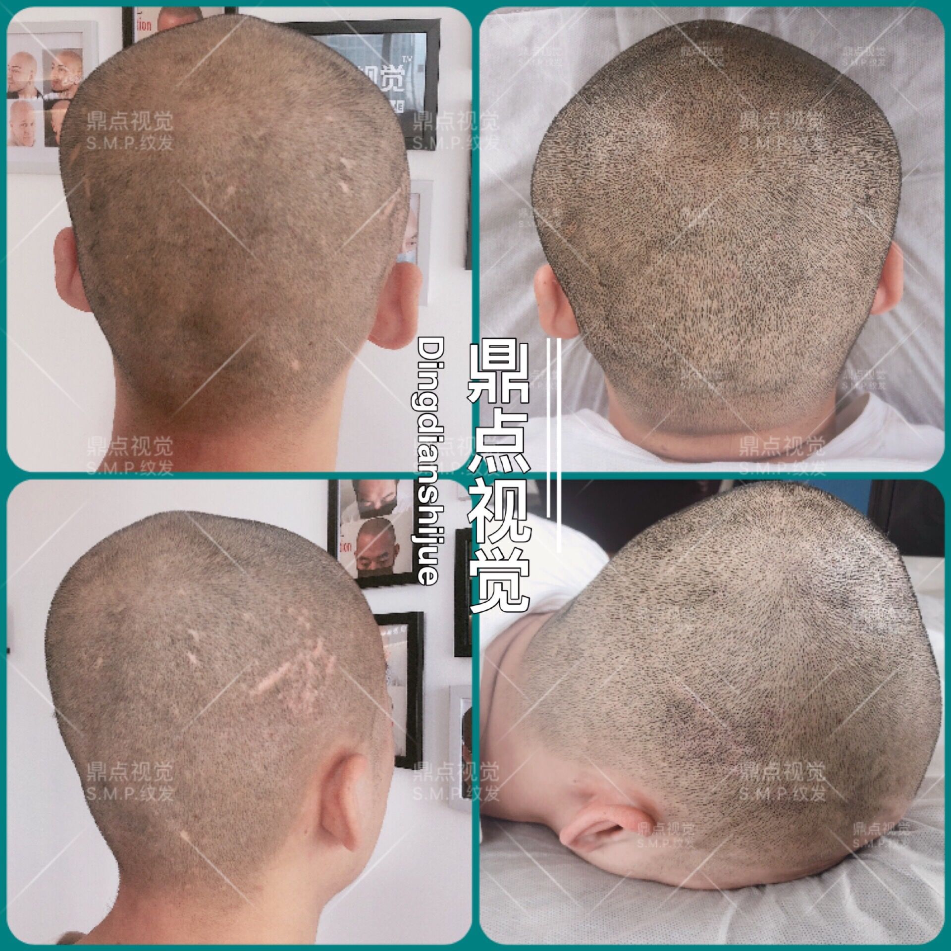 3D纹发补疤+头顶加密-纹发际线培训